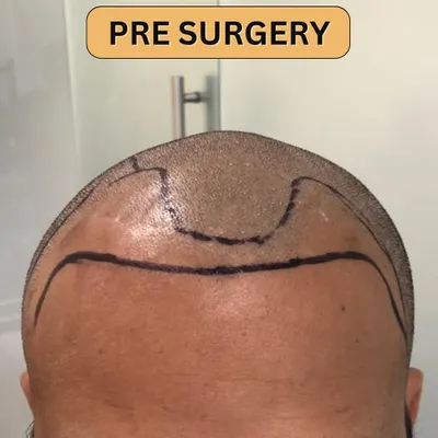 The journey begins with precise planning. Here, we've marked the new hairline pre-surgery, designing a natural frame for the face.