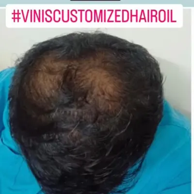 This is a 'before' photo from a client who was experiencing significant hair thinning on the crown area. He was looking for a natural way to address it.