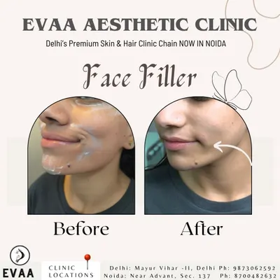 A clear before-and-after result of a face filler treatment. Notice the enhanced definition in the lower face and chin area, creating a more sculpted and balanced profile.
