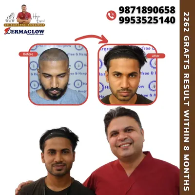 This client received 2262 grafts via the FUE technique, and this photo shows his results just 8 months post-procedure. Notice the restored hairline and the significant increase in density on the frontal and mid-scalp areas.