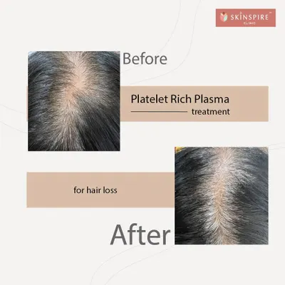 Here you can see the before and after results of a Platelet Rich Plasma (PRP) treatment. This non-surgical procedure is highly effective for tackling early-stage hair loss and thinning. Notice the significant improvement in hair density and scalp coverage, achieved by stimulating the hair follicles with the body's own healing properties.