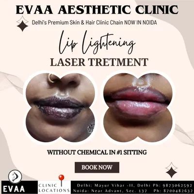 A dramatic before and after of our laser lip lightening treatment, showing significant improvement in pigmentation in just one sitting without the use of chemicals.