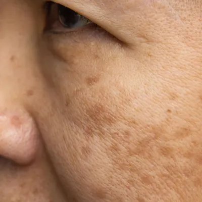 This close-up shows melasma, a common form of hyperpigmentation. My treatment focuses on a combination of sun protection, tyrosinase inhibitors to block pigment production, and gentle procedures like Q-switched lasers to gradually break down existing melanin.