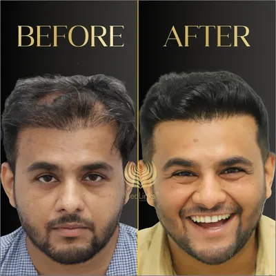 The smile says it all. This patient came to us with significant hair loss and left with renewed confidence. This before and after result shows the dramatic yet natural-looking change possible with a well-planned hair transplant.