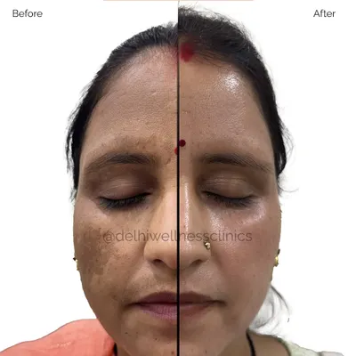 This split-face view clearly shows the significant reduction of melasma on one side of the face compared to the untreated side. This method helps clients see the progress session by session.