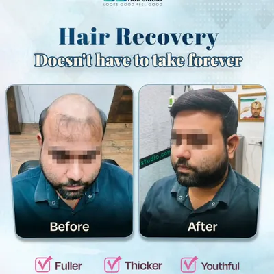 A clear demonstration of how our hair patch treatment effectively covers advanced male pattern baldness. The result is a fuller, thicker head of hair that looks youthful and completely natural from every angle.