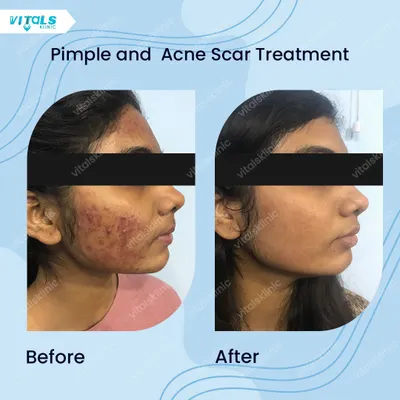 A clear example of a successful acne and scar treatment plan. We progressed from managing active pimples and inflammation to reducing the appearance of scars, resulting in smoother skin texture and a more even tone.