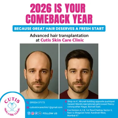 This before and after comparison is a testament to the life-changing results of our hair transplant surgery. The patient's hairline is fully restored, and the density creates a youthful, natural appearance that is virtually indistinguishable from a natural head of hair.