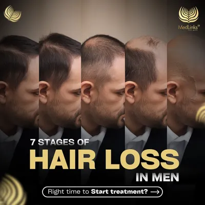 Hair loss happens in predictable stages. This series will help you understand the 7 stages of male pattern baldness and identify the right time to start treatment.