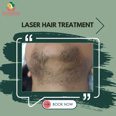This image shows the significant reduction of coarse hair on the chin and neck area after a course of laser hair treatments. The result is smoother skin and a more defined jawline.