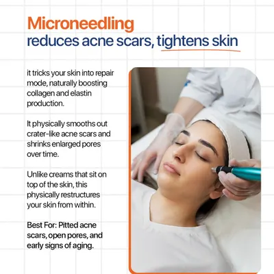 This graphic explains how microneedling works by tricking your skin into repair mode. This process naturally boosts collagen and elastin, physically smoothing out pitted acne scars and shrinking enlarged pores over time.