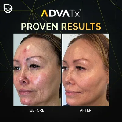 This before and after image is a clear testament to the transformative power of the ADVA Tx laser. Notice the significant reduction in redness, blemishes, and fine lines, resulting in a smoother and more radiant complexion.