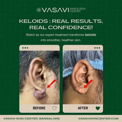 This is another example of a successful earlobe keloid reduction. My treatment protocol aims to significantly flatten the scar tissue and restore a more natural ear contour, relieving the discomfort and cosmetic concerns associated with keloids.