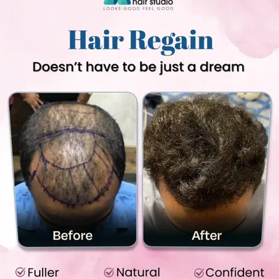 Regaining your hair is not just a dream. This before and after comparison shows a complete transformation, covering the crown area to achieve a fuller, natural, and more confident look.
