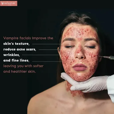 The "vampire facial," or PRP microneedling, is a powerful regenerative treatment. It is highly effective for improving skin texture, reducing the appearance of acne scars, and minimizing fine lines by stimulating your body's natural healing process.