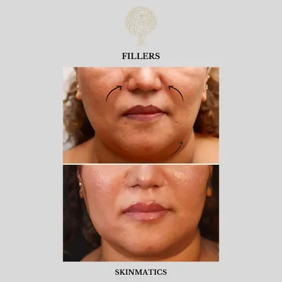 This is a great example of a full-face rejuvenation using dermal fillers. We addressed the cheeks, nasolabial folds, lips, chin, and under-eye area to restore youthful volume and create a harmonious, lifted appearance.