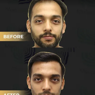 This is a frontal view of a corrective hair transplant. The 'before' image shows an unnatural, pluggy hairline from a previous procedure elsewhere. Our 'after' result demonstrates a soft, natural, and dense hairline that completely corrects the past mistake.