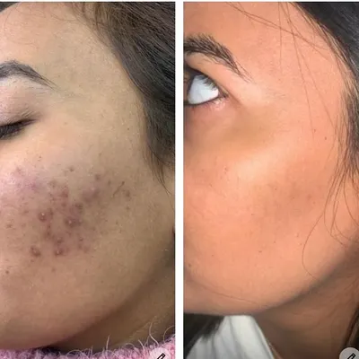 This is a clear example of the results we can achieve for post-acne blemishes and inflammation. After a series of six personalized chemical peel sessions, you can see a significant reduction in active acne and a dramatic improvement in skin texture and tone. My goal is always to restore the skin's health, not just treat the surface.