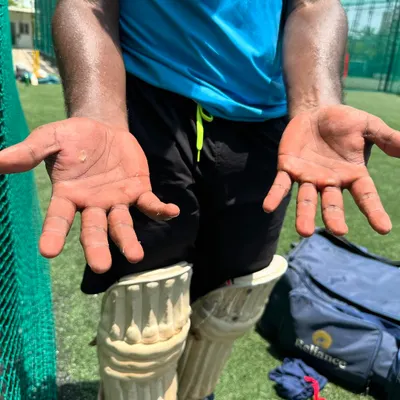 The hands of a batsman after a long session. This is what dedication looks like. The blisters are temporary, but the skill is permanent.