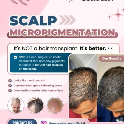 Scalp Micropigmentation is a game-changer for concealing thinning hair. As this graphic shows, it gives the illusion of a fuller head of hair by replicating natural follicles. It's a safe, non-surgical option with immediate results.