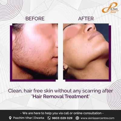 This before and after shows the effectiveness of laser hair removal on the face, resulting in clean, hair free skin without scarring. This is a common treatment for achieving a smoother complexion.