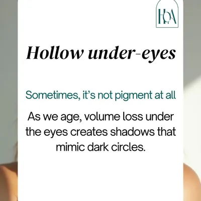 Sometimes, what you think are dark circles are actually hollow under-eyes. As we age, volume loss in this area creates shadows that mimic pigmentation. This is a concern that eye creams can't fix, but fillers can.