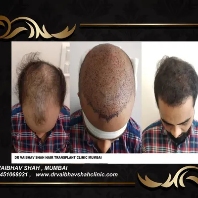 This series shows the complete journey for a patient with advanced baldness: from the initial state, to the scalp immediately after graft implantation, and finally the grown-out result.