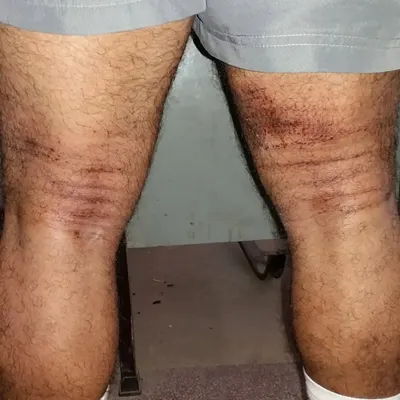 This is the sweet pain of equipped lifting. These scrapes on my legs are from a tight deadlift suit. If someone says equipped is easy, they have never tried it.