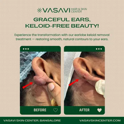 This image shows the significant reduction of a large earlobe keloid. My focus is on not just removing the keloid but also restoring the natural shape of the ear, providing both a physical and confidence-boosting transformation.