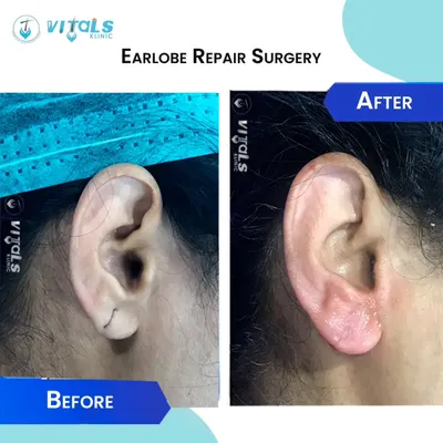 A clear before-and-after of a torn earlobe repair. This surgical procedure carefully stitches the split tissue back together, creating a smooth, healed lobe that can be re-pierced later.