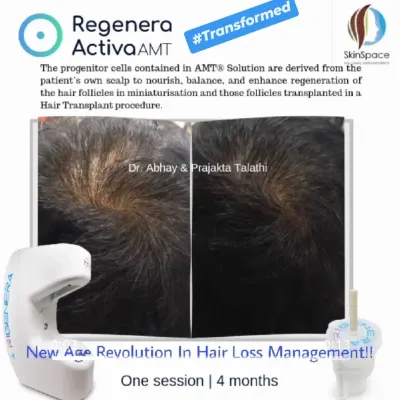 This transformation was achieved after just one session of Regenera Activa, with results documented at 4 months. The treatment effectively increased hair density and coverage at the crown, a common area of concern for male pattern hair loss.