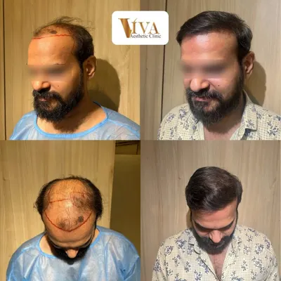 This patient's journey is a powerful example of regaining confidence. The before and after photos speak for themselves, but his feedback about the process is what truly matters.