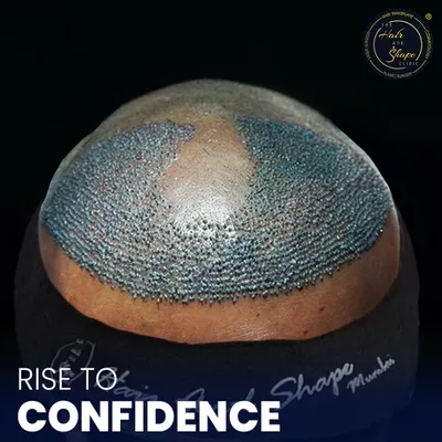 This top-down view shows the immediate result of an FUE hair transplant. You can see the newly implanted follicles creating the foundation for a fuller crown and a restored hairline.