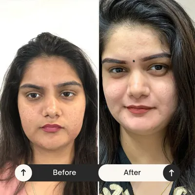Another incredible transformation from my Miracle Facial. You can see a visible reduction in texture and a significant boost in brightness and clarity after just one session. Consistent aftercare with my products ensures these results last.