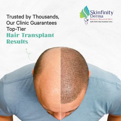This is the power of a well-executed hair transplant. We focus on creating a natural-looking hairline and dense coverage, permanently solving hair loss concerns for our patients.