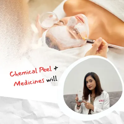 For treating acne, a combination approach is often most effective. This visual explains that a chemical peel, when paired with the right prescribed medicines, can significantly reduce acne and prevent future breakouts.
