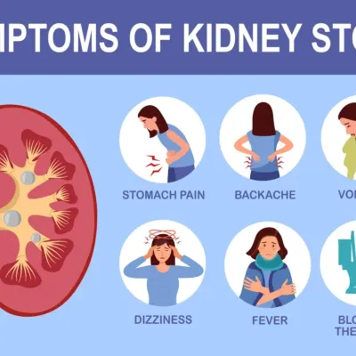 Recognizing the signs of kidney stones is the first step towards getting relief. This guide shows common symptoms like sharp back or stomach pain, fever, and changes in urination that you should not ignore. Early diagnosis helps in more effective non-surgical treatment.