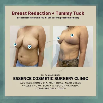 This image shows the transformative result of a Mommy Makeover, combining a breast reduction with a 360 Hi-Def Vaser Lipoabdominoplasty. The 'after' photo displays lifted, more proportionate breasts and a significantly flatter, more toned abdomen.