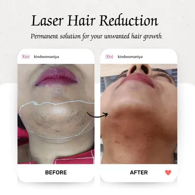 A visible reduction in chin hair after laser treatment. This before and after demonstrates how we effectively target and reduce unwanted facial hair, resulting in clear, smooth skin.