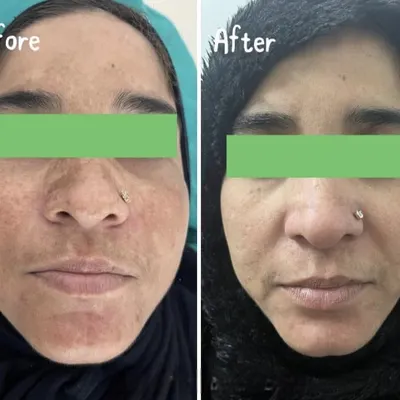 A clear example of our success in treating hyperpigmentation. Through a personalized plan including professional treatments and prescribed oral medication, we achieved a visibly more even and brighter skin tone for our client.