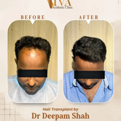 This patient came to me with Grade 3 hair loss. Using 3700 grafts, we successfully restored density to his frontal scalp and recreated a natural, age-appropriate hairline. This is the 10-month result, viewed from the top.