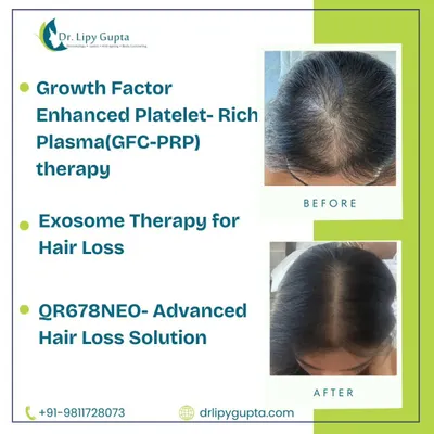 This is the kind of transformation that is possible with a consistent, medically-guided hair restoration plan. This patient's results were achieved through a combination of advanced treatments, showing a significant improvement in hair density and scalp coverage.