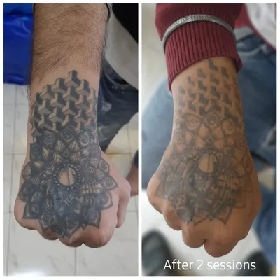 This before and after comparison shows the progress on a dark ink hand tattoo after just two removal sessions. The geometric patterns and mandala design are visibly lighter, demonstrating the effectiveness of the laser treatment process.