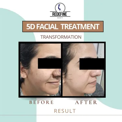 A fantastic before and after result from our 5D Facial Treatment. You can see a visible improvement in skin tightness and a reduction in fine lines, resulting in a more youthful and refreshed appearance.