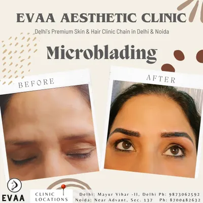 A powerful before and after example of our work. We transformed sparse and undefined brows into a perfectly shaped and full set that frames the eyes beautifully, eliminating the need for daily makeup.