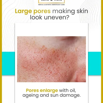 Large pores can make skin appear uneven and are a common concern. They are typically a result of excess oil production, natural aging, and accumulated sun damage over the years.
