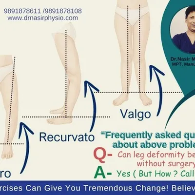 Many aspirants for uniformed services are concerned about leg deformities like genu varum (bow legs) or genu valgum (knock knees). This diagram shows these conditions, which we can often correct with specific exercises and physiotherapy, without needing surgery.