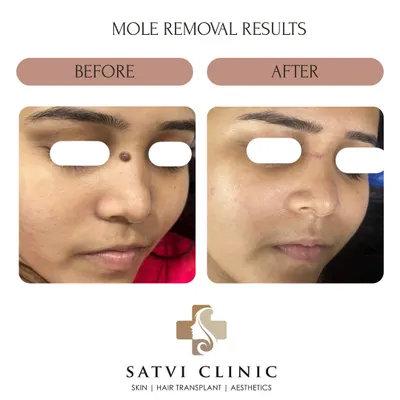 This before-and-after shows the result of a dermato-surgical mole removal I performed on a patient's face. My goal is always a scar-minimal outcome, using precise techniques in a sterile environment to ensure both safety and the best possible cosmetic result.