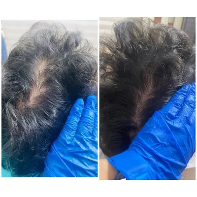 Here is a clear before and after comparison showing the power of a targeted treatment plan. This patient's hair density visibly improved after three sessions of GFC, demonstrating how we can effectively combat hair thinning.