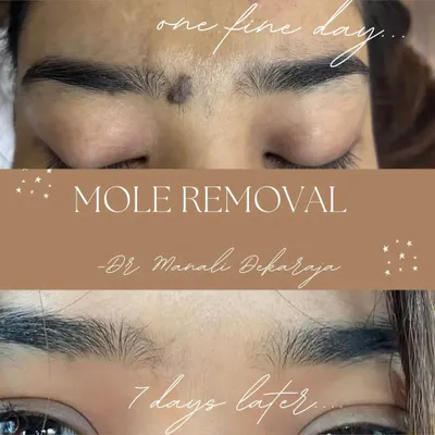 This before-and-after image shows a mole removal performed by Dr. Manali Deharaya. The mole between the eyebrows was safely removed, with the skin looking clear and smooth just seven days later.